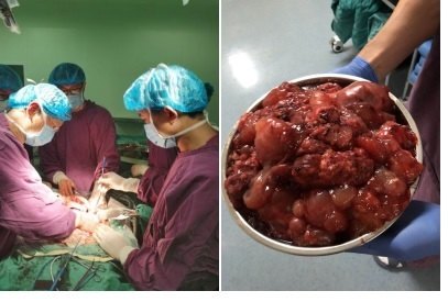 手术过程中及切除肿瘤标本