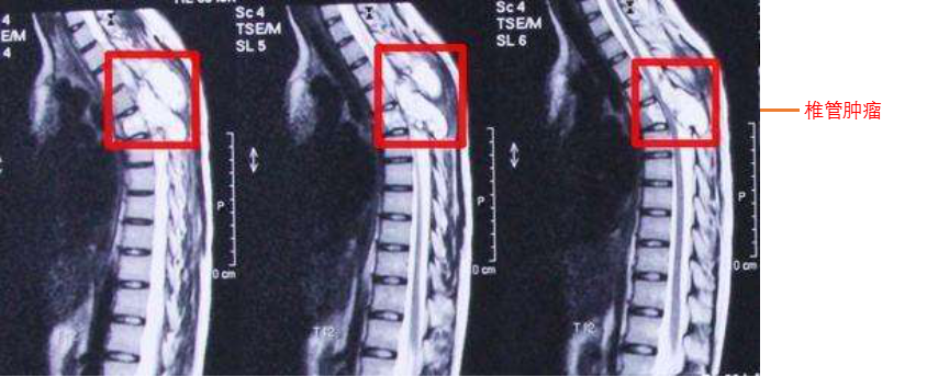 椎管肿瘤什么是椎管肿瘤