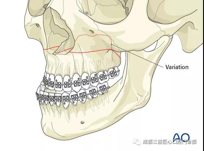 正颌就是动骨头? 一篇关于正颌手术的科普