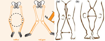 儿童常见的下肢畸形