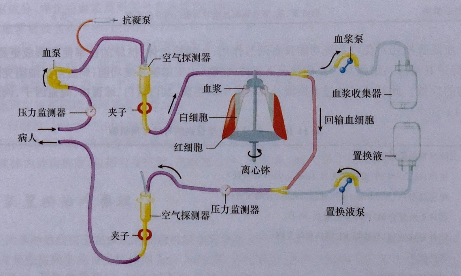 揭秘系列之六"洗血疗法—血浆置换/免疫吸附