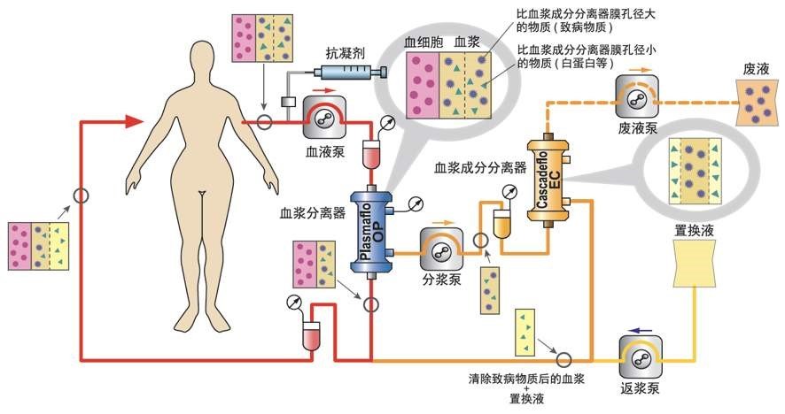 揭秘系列之六"洗血疗法—血浆置换/免疫吸附