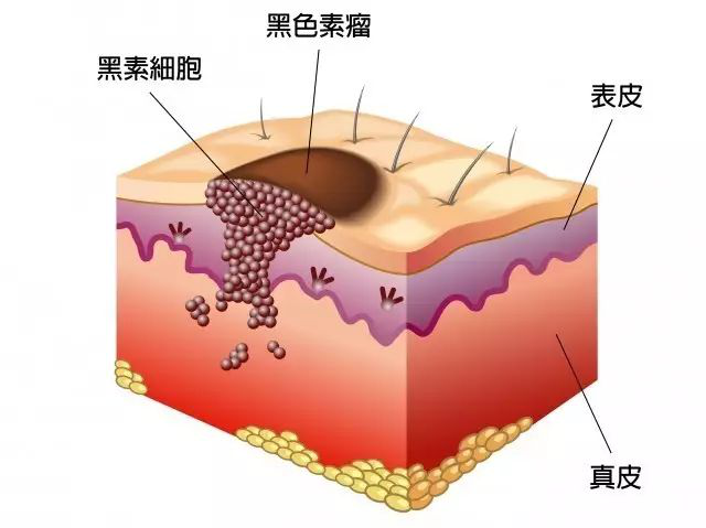 如何区分黑痣还是黑色素瘤