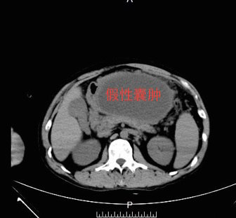 胰腺肿瘤的微创治疗3:腹腔镜下胰腺假性囊肿空