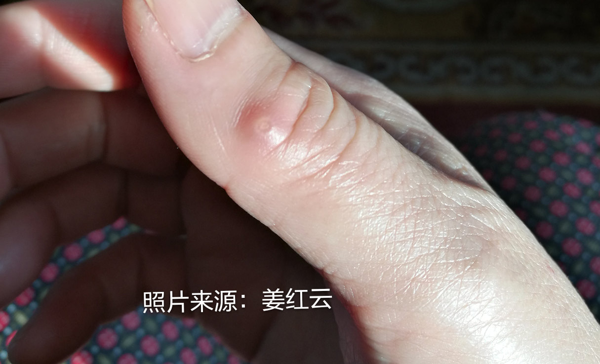 您见过手上长鸡眼吗?