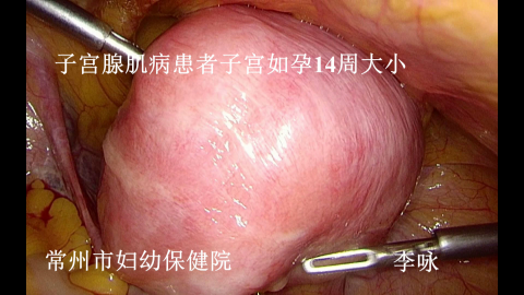 李咏腺肌病手术6.png