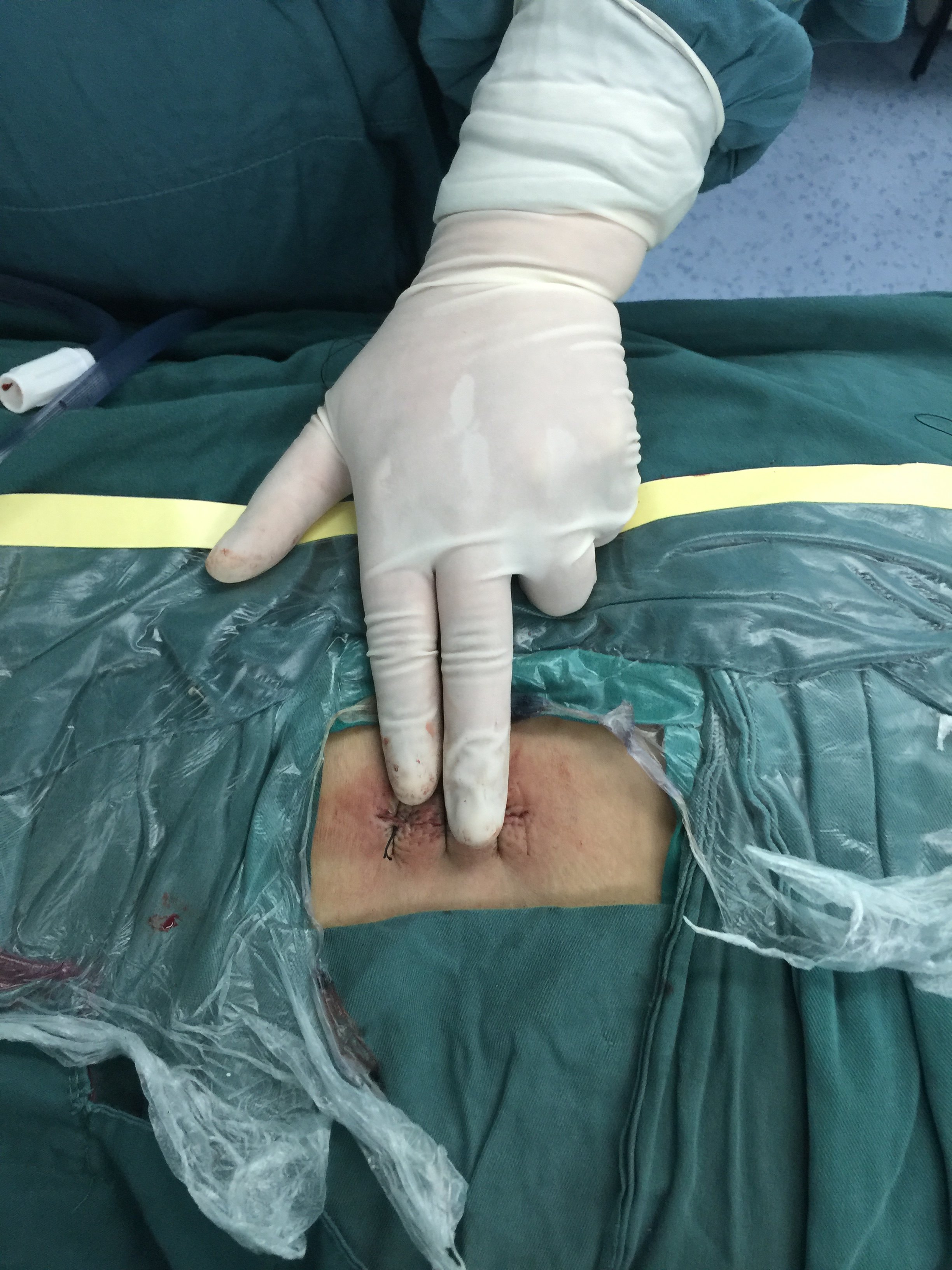 而腰椎间盘突出髓核显微切除术是手术治疗的金标准,小切口,创伤小