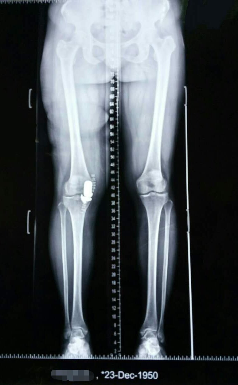67岁女性,膝关节骨性关节炎,微创单髁关节置换. (原创)