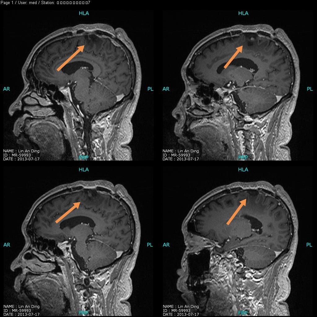 显微手术切除功能区矢状窦旁脑膜瘤