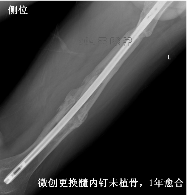 成人股骨干骨不愈合(五):髓内钉要正确使用      男性,44岁,多发 骨折