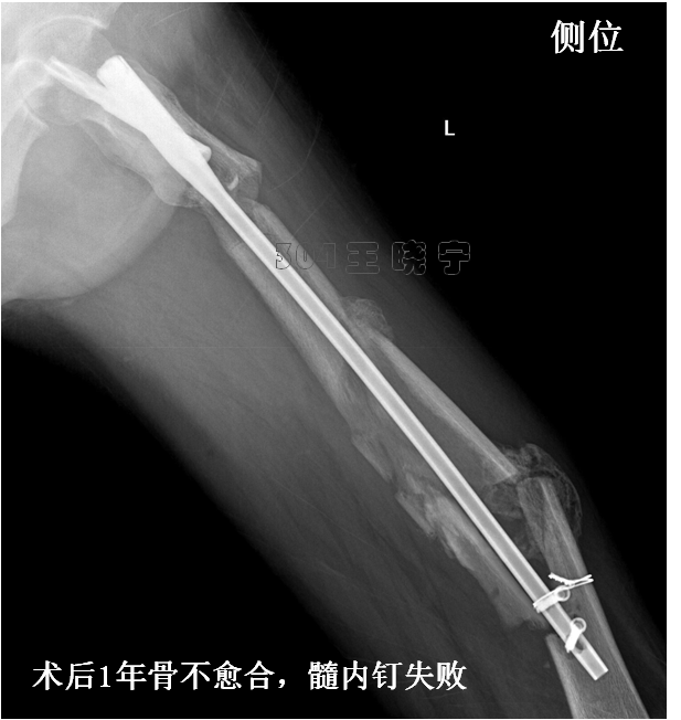 成人股骨干骨不愈合五髓内钉要正确使用