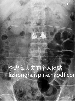 脊柱微创手术治疗骨质疏松性椎体骨折疗效及预后观察