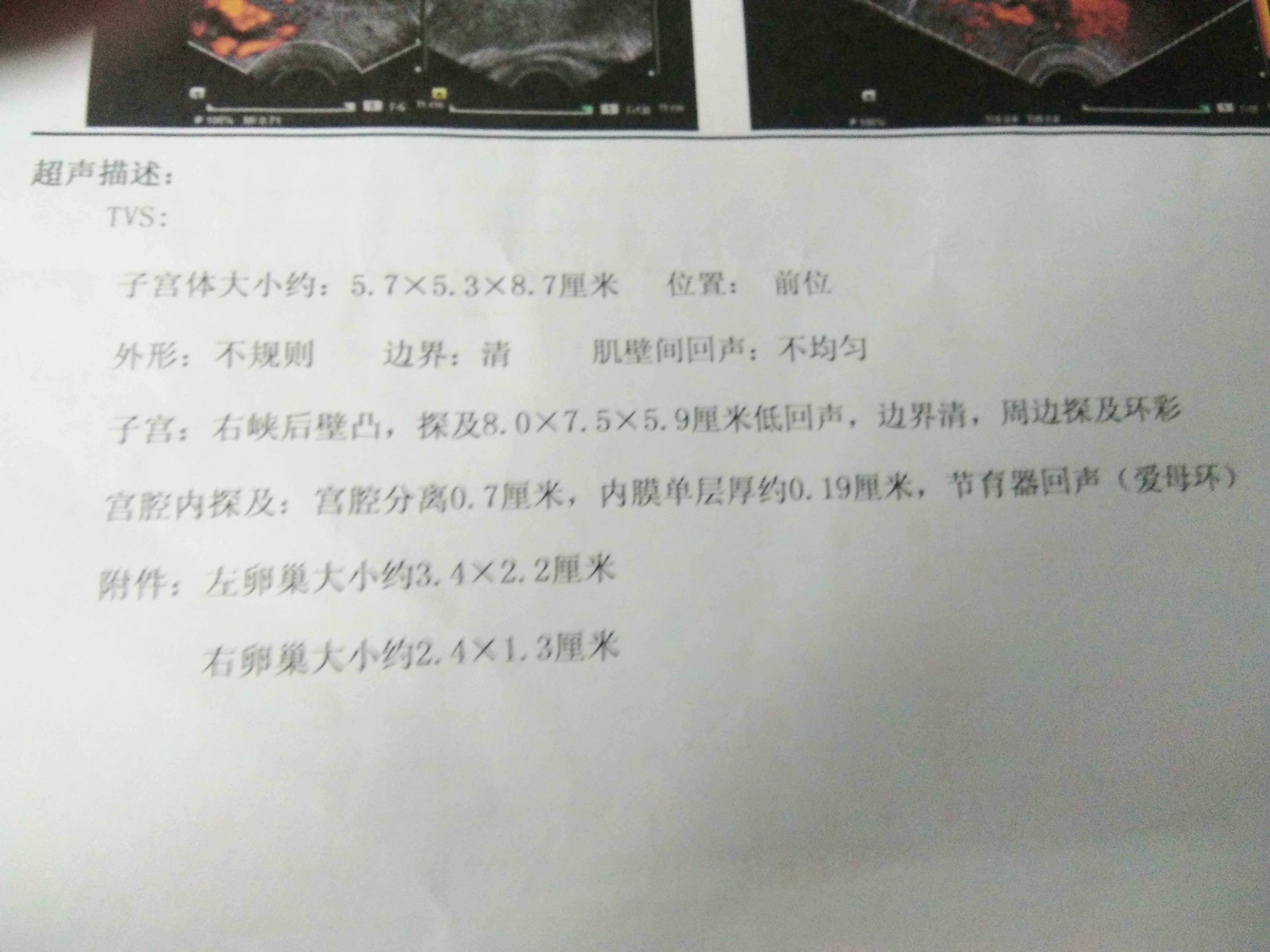 子宫后壁峡部子宫肌瘤――直径约9cm