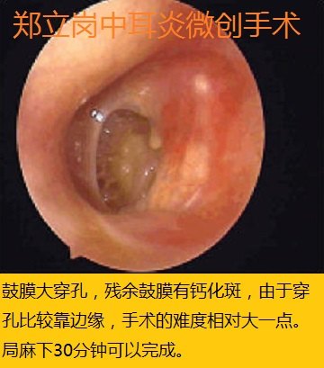 慢性化脓性中耳炎耳内镜微创手术第424广东江