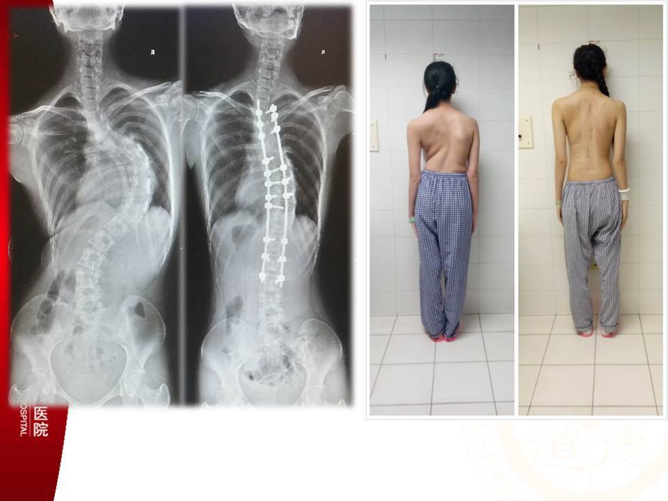 Less invasivs scoliosis10.16.jpg