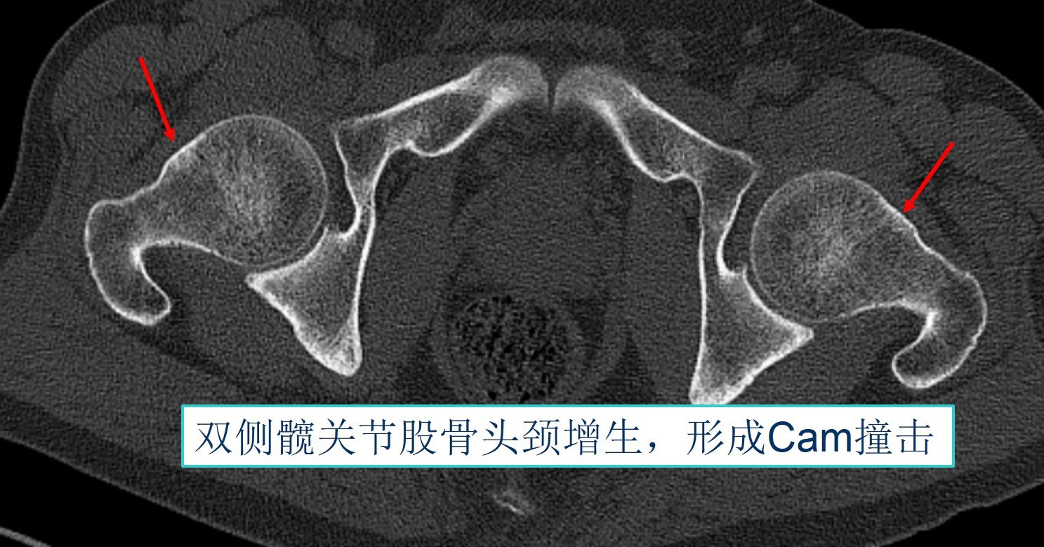 髋关节镜技术-髋关节撞击综合征(fai)的治疗