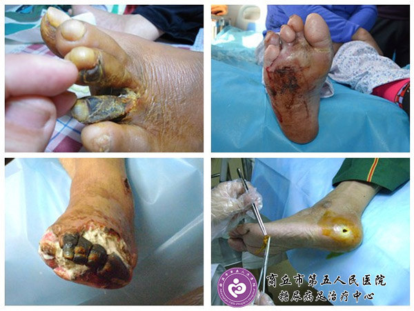 糖尿病患者腿疼走不动路什么原因