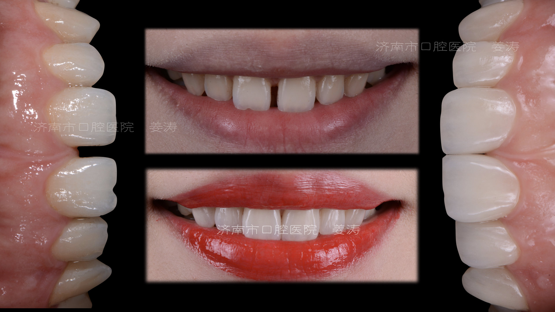 全瓷贴面关闭间隙