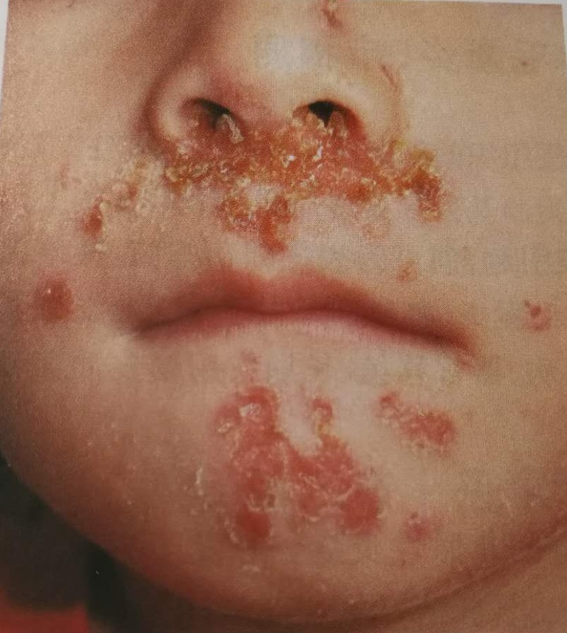 接触传染性脓疱疮