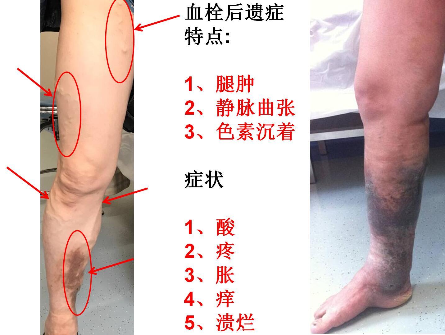 1513220597487304.jpg pts症状.jpg