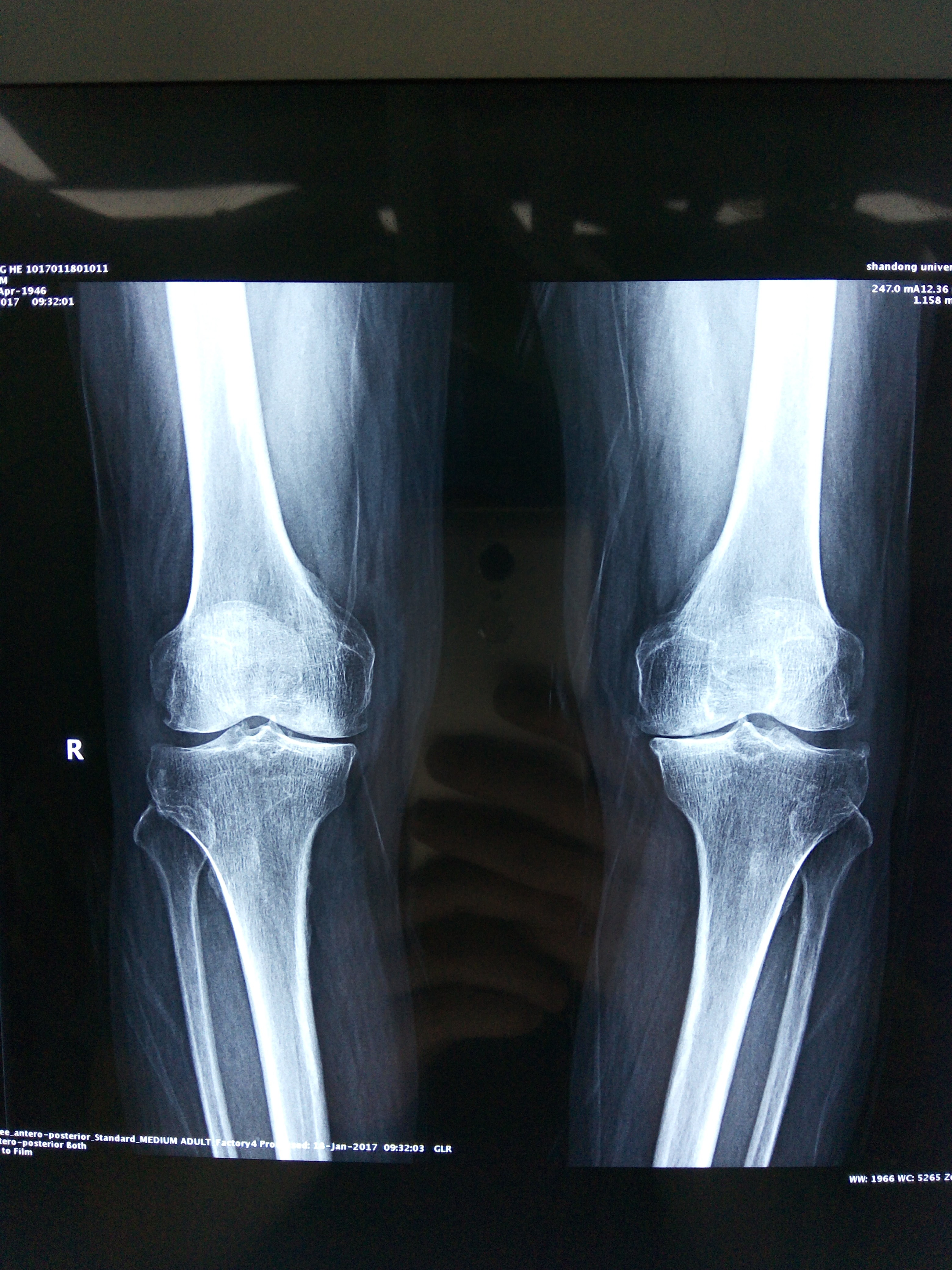 膝关节骨性关节炎行关节置换术