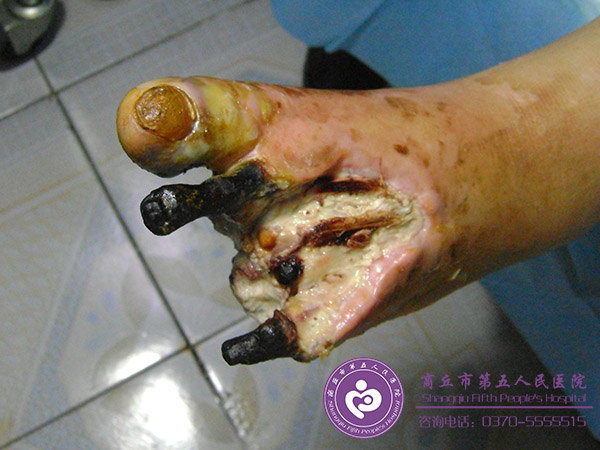 糖尿病足患者乱敷药导致恶化案例分析