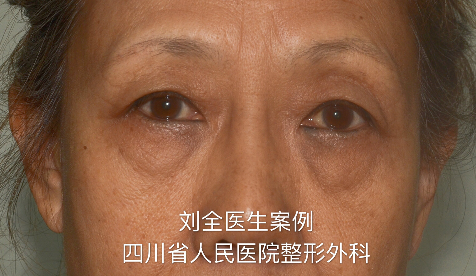 好大夫在线 刘全 > 外切口眼袋案例分享(二)发表者:刘全1442人已读