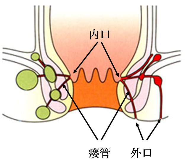 董秀山 文章列表 肛裂是位于肛管末端到齿线的一个线性或椭圆形撕裂