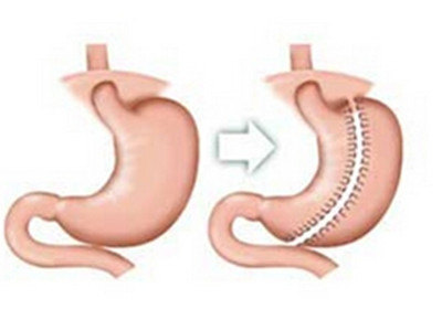 缩胃手术是怎么回事?
