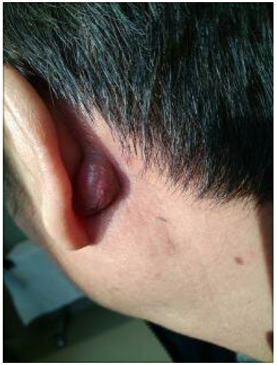 耳朵上的包块:粉瘤