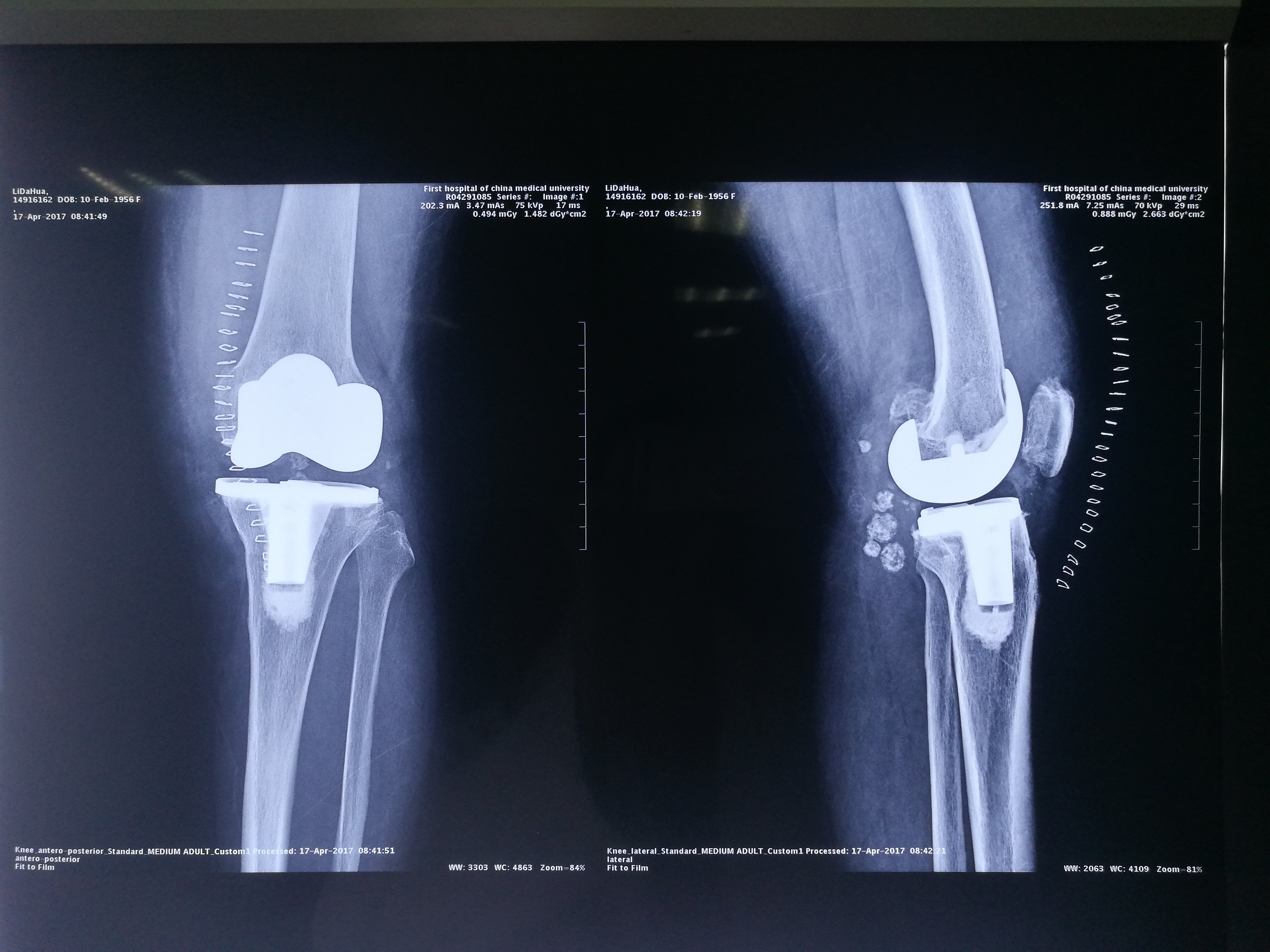 61岁女性膝关节滑膜软骨瘤病关节炎全膝关节置换术