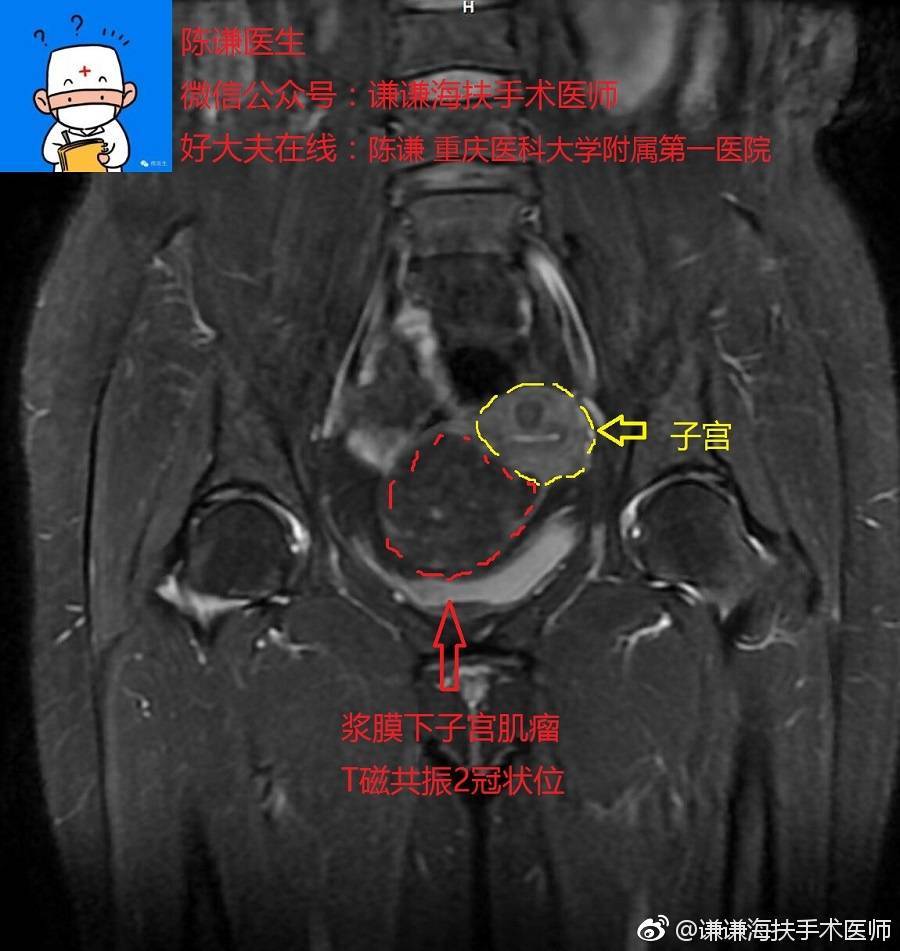 浆膜下子宫肌瘤如何治疗?
