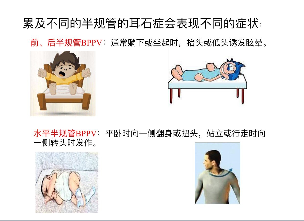 16张图片教您认识一种眩晕病~~耳石症
