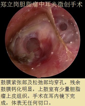 胆脂瘤中耳炎耳内镜微创手术第438浙江杭州富