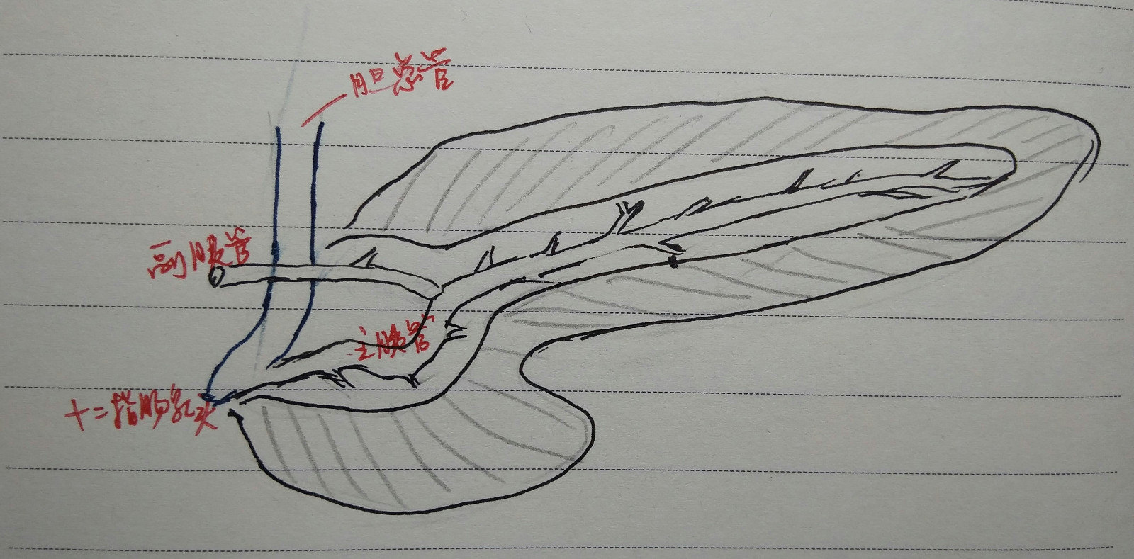 结石君是怎样得胰腺炎的?