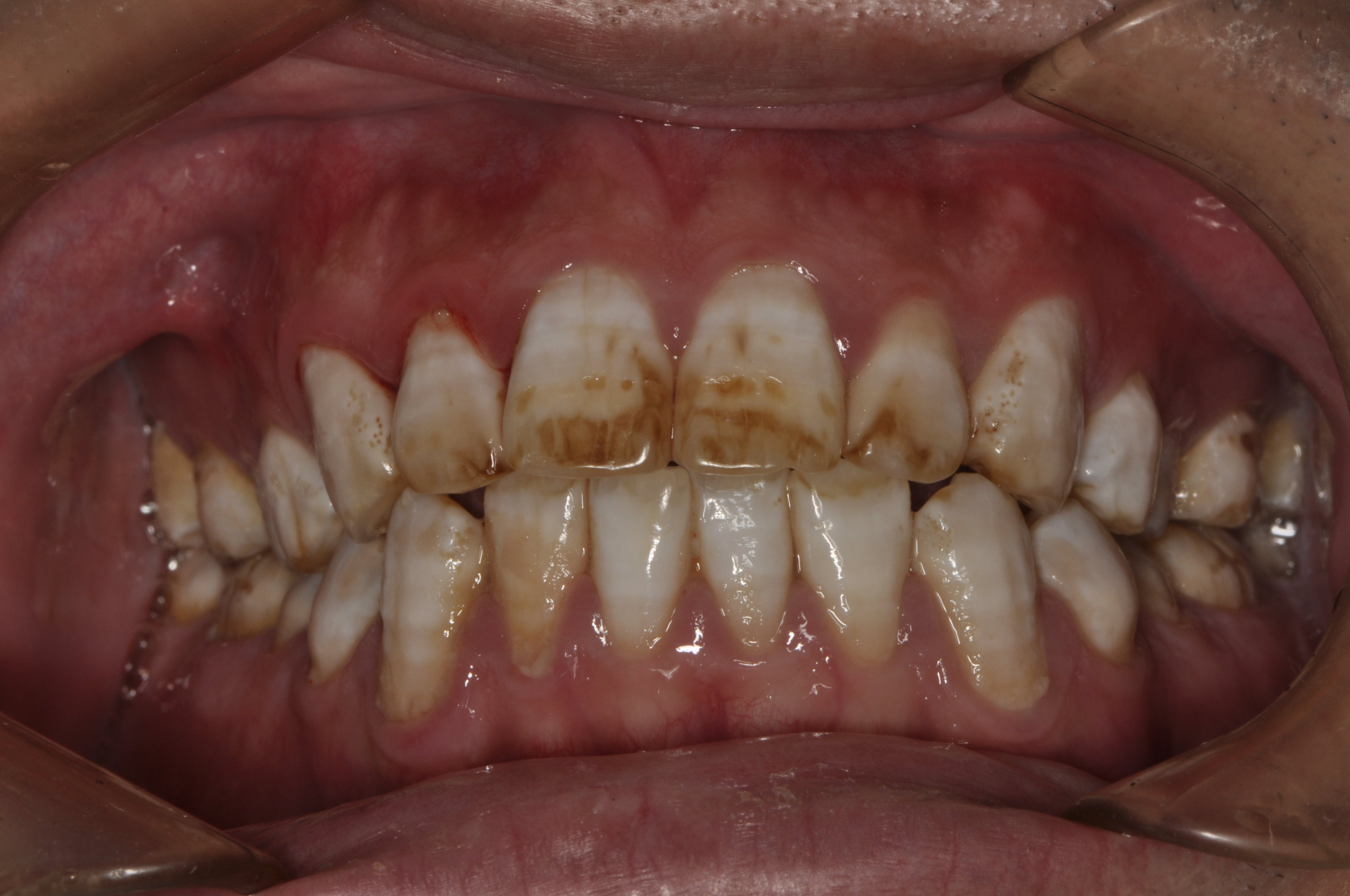 氟斑牙美白患者一例_好大夫在线