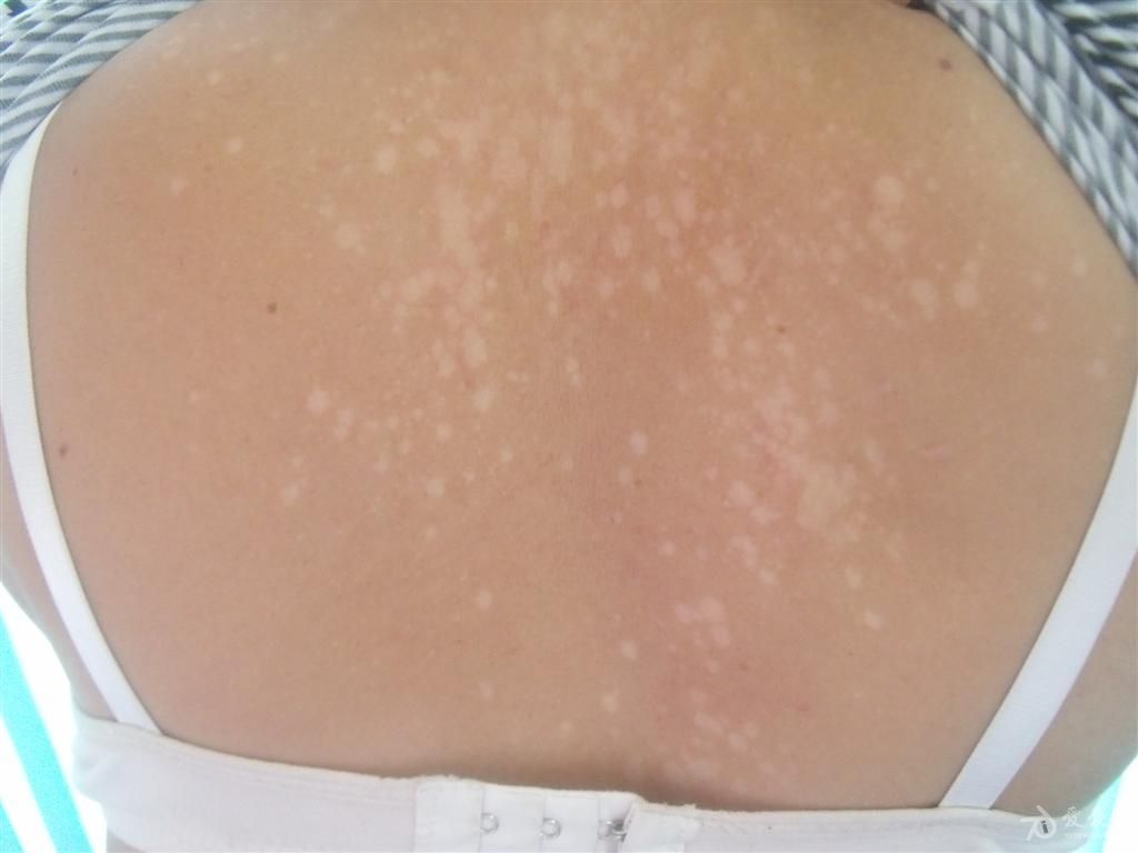 花斑癣 花斑糠疹 汗斑的预防与治疗