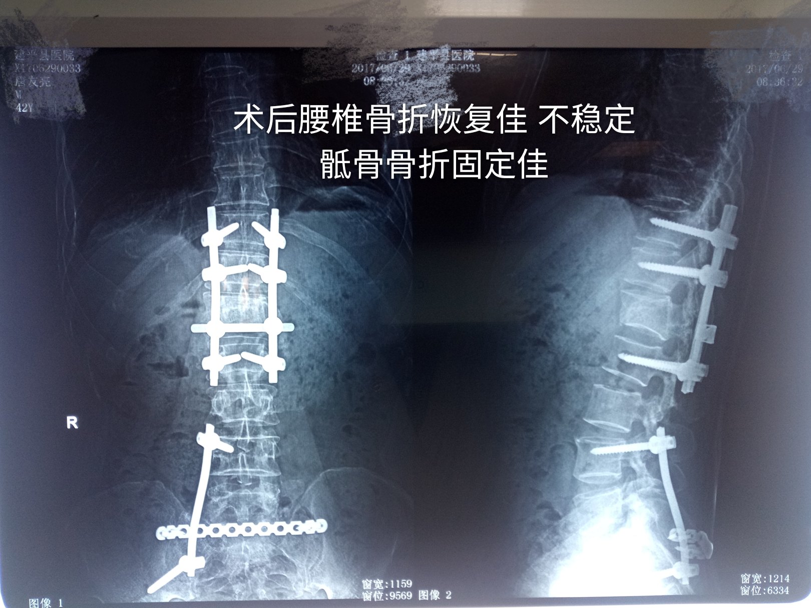 胸椎爆裂骨折 脊髓损伤 骶骨不稳定骨折 骶神经损伤