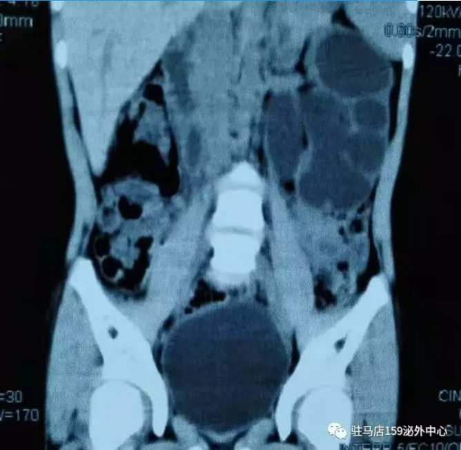 一例重复肾合并输尿管狭窄的后腹腔镜离断成型