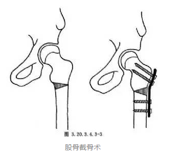 股骨头坏死的诊断与治疗 - 好大夫在线 ·智慧