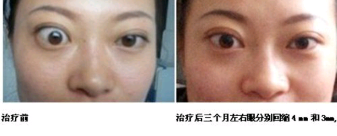 甲亢突眼的放射治疗