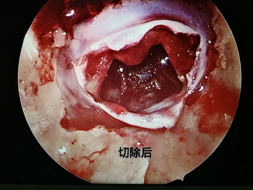 应用神经内镜治疗一例垂体瘤