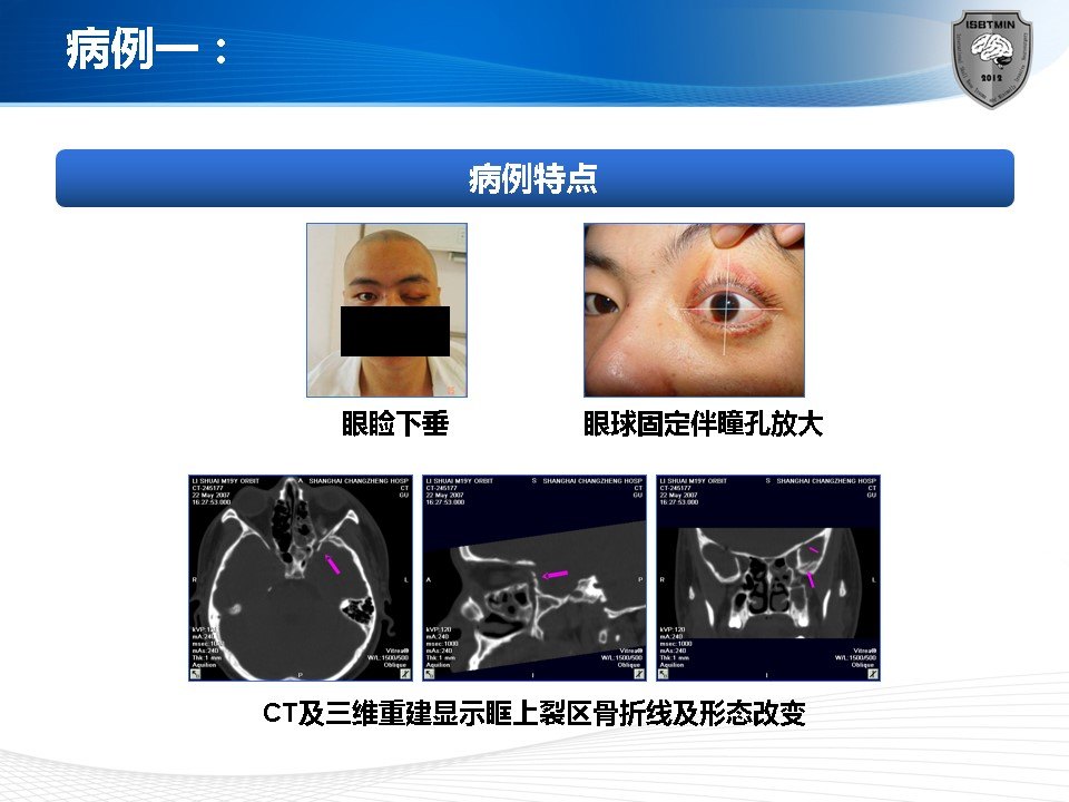 眶上裂综合症的微创手术治疗