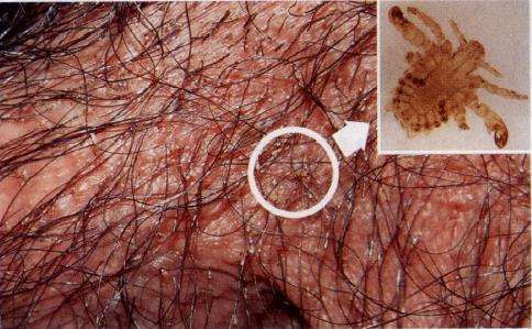 突然发生的阴毛部剧烈瘙痒是咋回事--阴虱病是