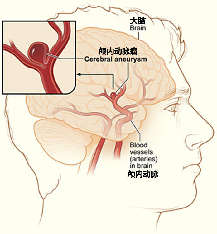 颅内动脉瘤:带您认识脑内"不定时炸弹"