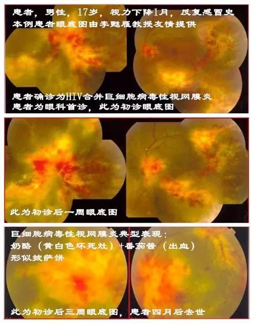 陶勇 文章列表 >艾滋病眼病的临床表现和治疗   艾滋病可以引起眼部微
