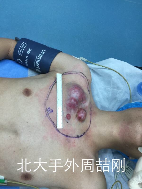 胸壁巨大隆突性皮肤纤维肉瘤的根治性切除