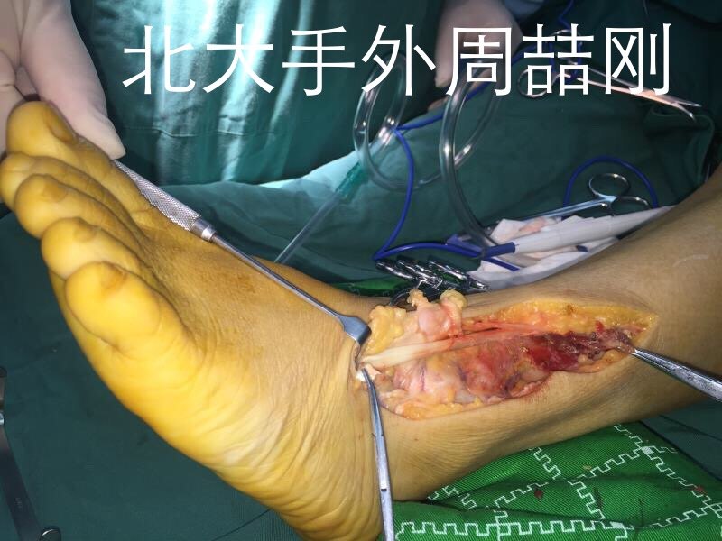 有图有真相足踝部肌内血管瘤的手术切除和肌腱移植重建