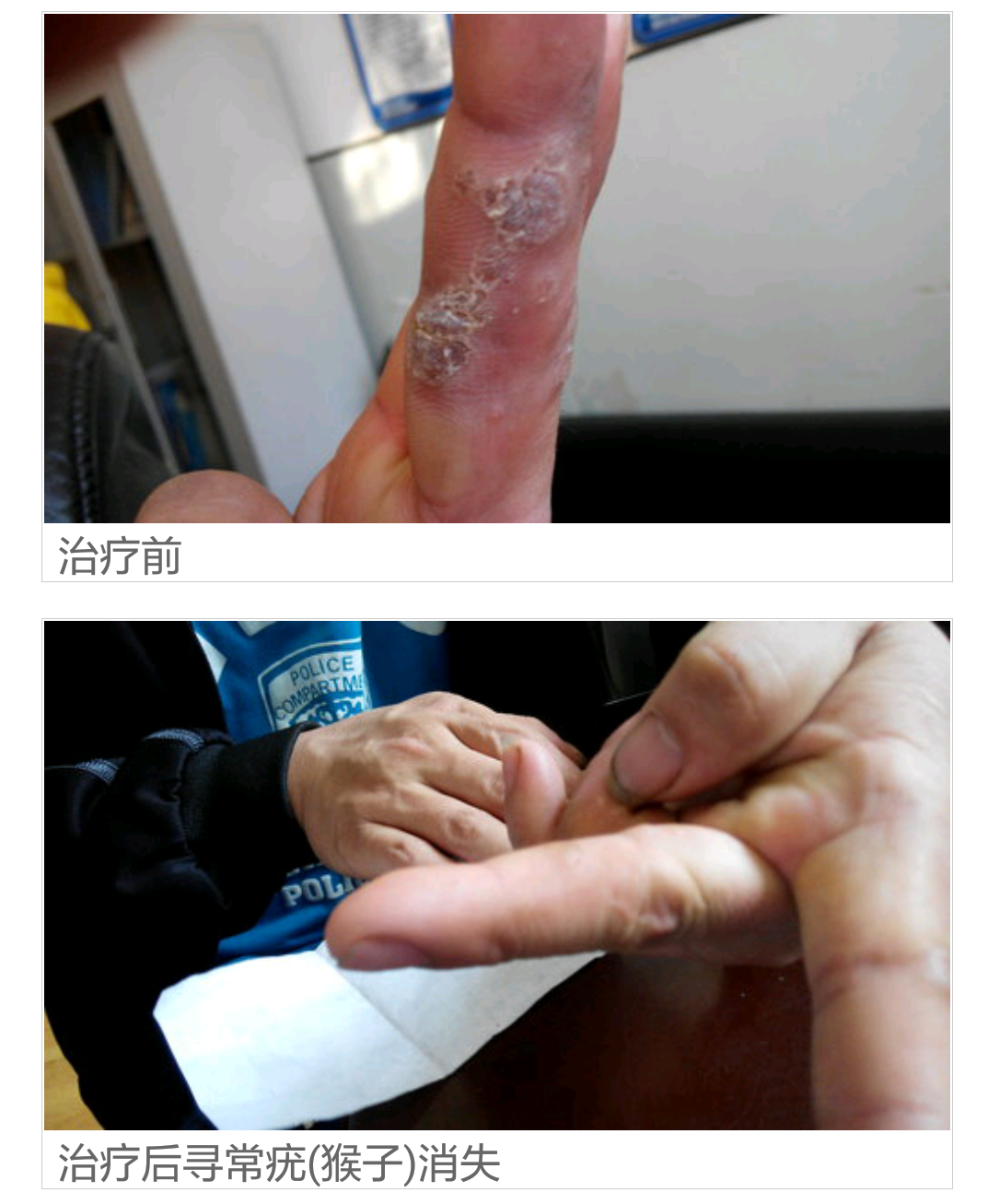 同位素敷贴能彻底治愈寻常疣(瘊子)(山东青岛)