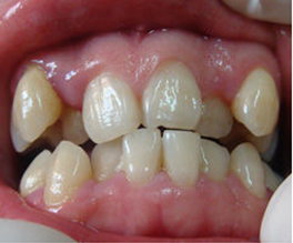 小儿腺样体肥大怎么办?